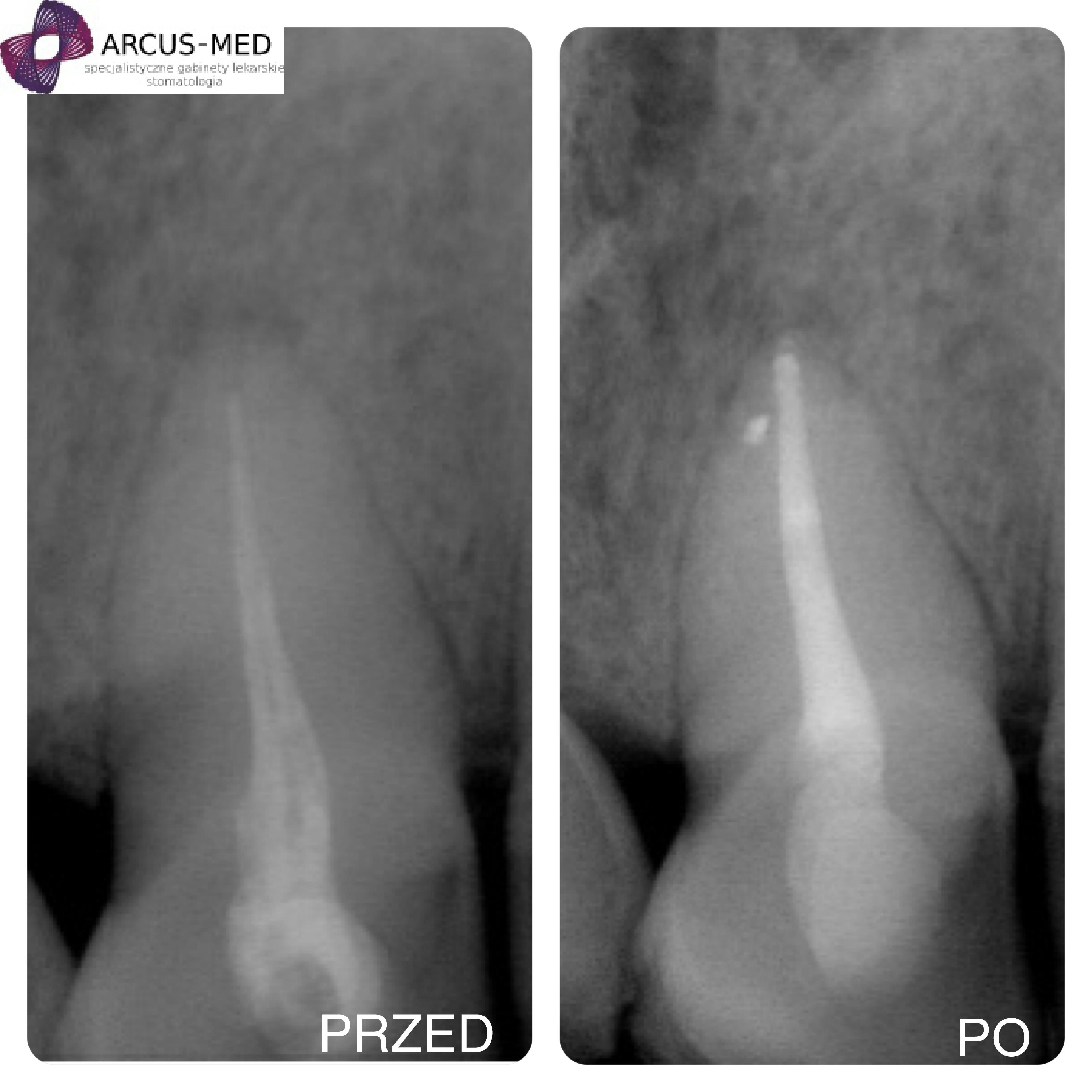 Zdjęcie zęba przed i po leczeniu kanałowym