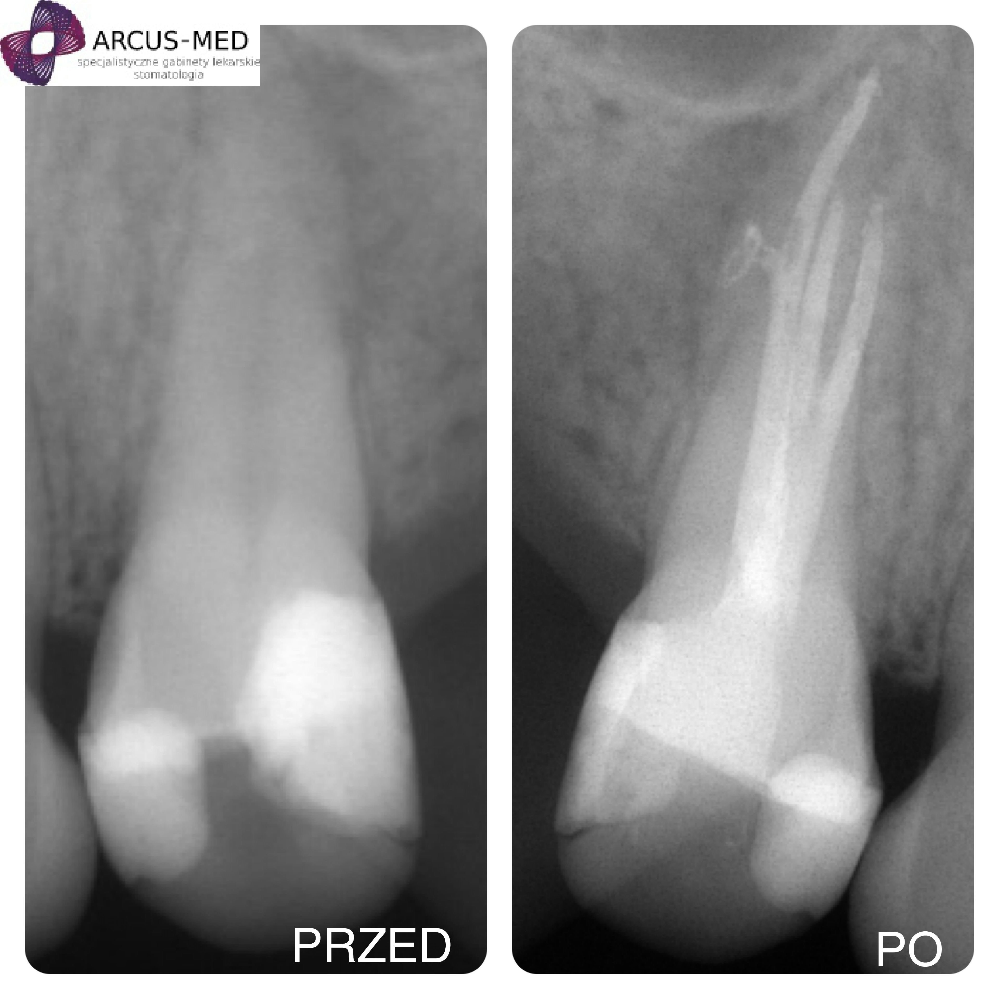 Zdjęcie zęba przed i po leczeniu kanałowym